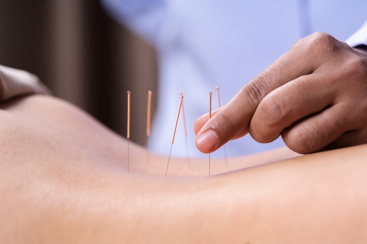 Sekilas Akunpunktur Medik