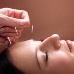 Manfaat Akupunktur Wajah: Cara Alami Biar Kulit Kencang dan Glowing!