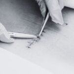 Akupunktur untuk Rehabilitasi Pasca Operasi | Klinik Wangbi