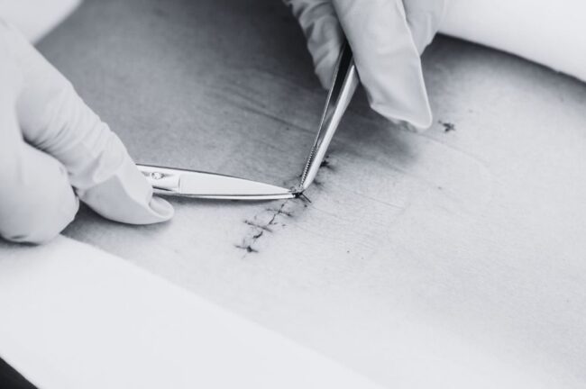 akupunktur untuk rehabilitasi pasca operasi