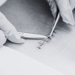 akupunktur untuk rehabilitasi pasca operasi