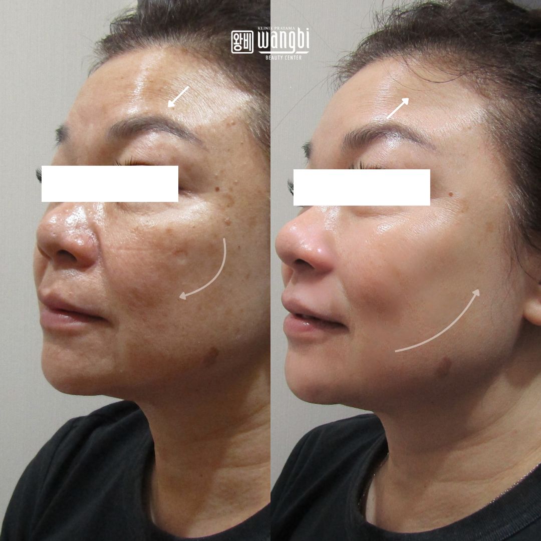 Before After 1