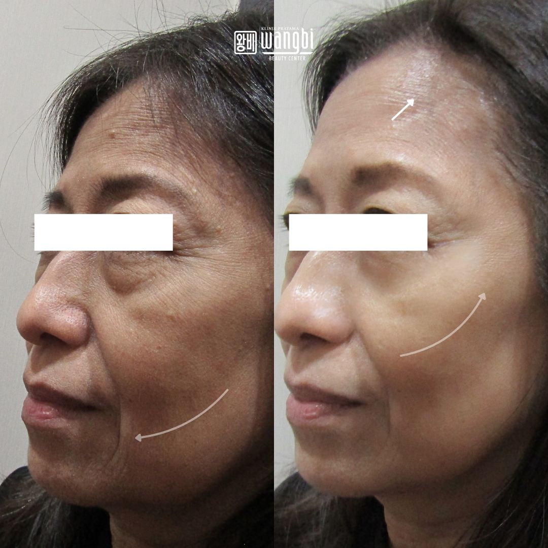 Before After 2
