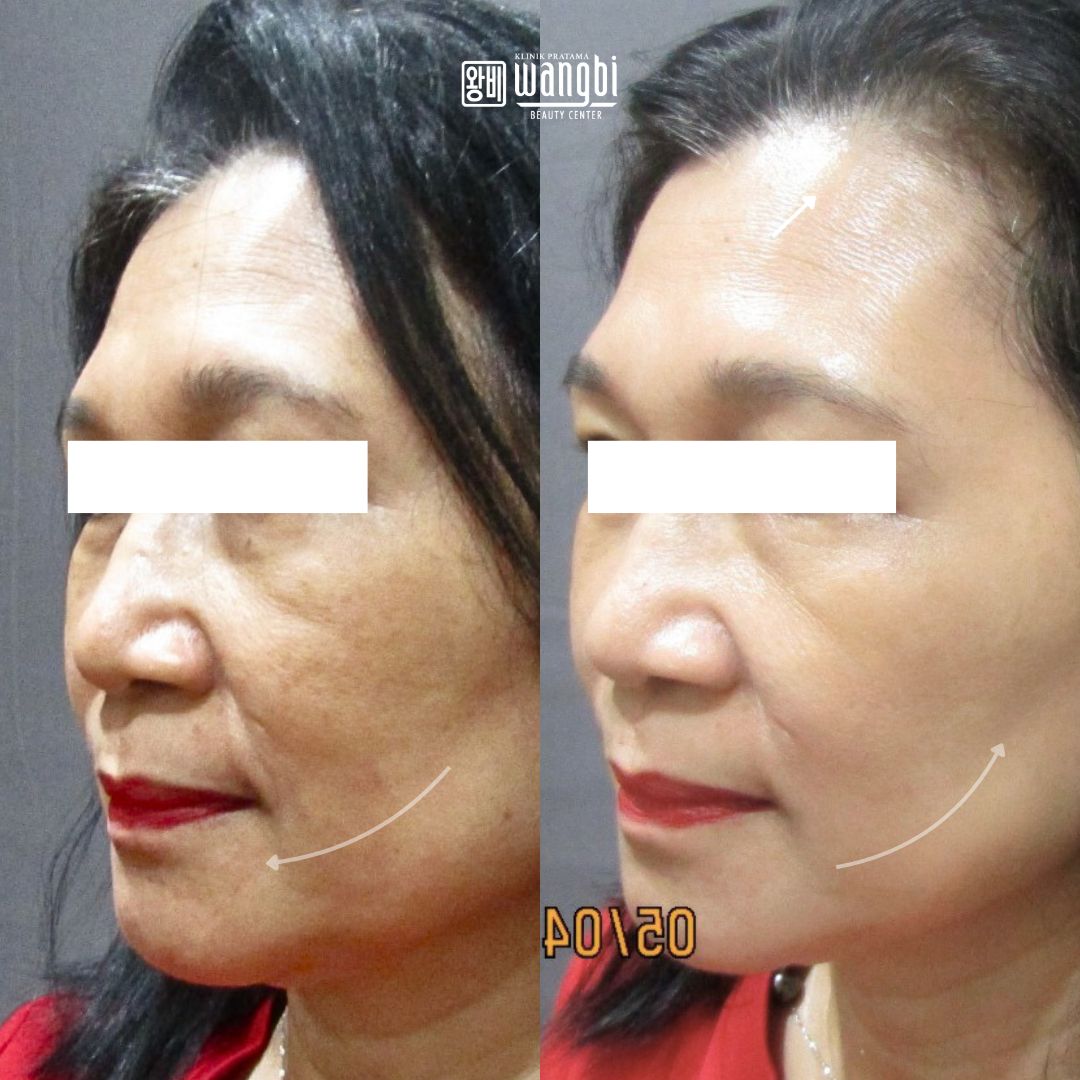 Before After 3