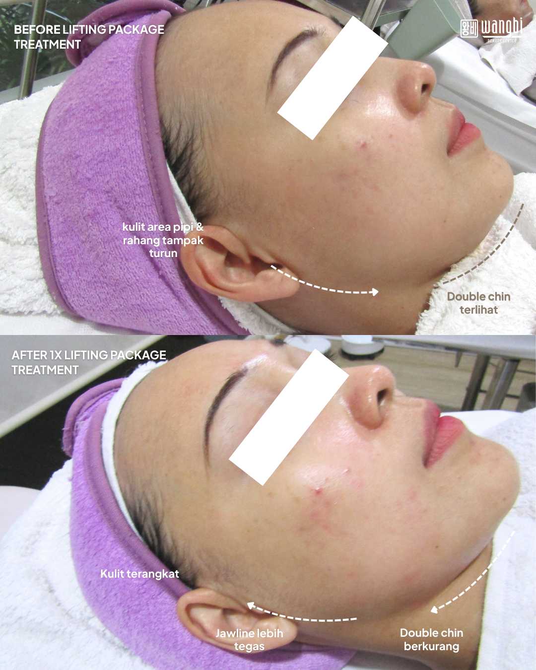 Before After Akupunktur Facelift - Kontur Wajah