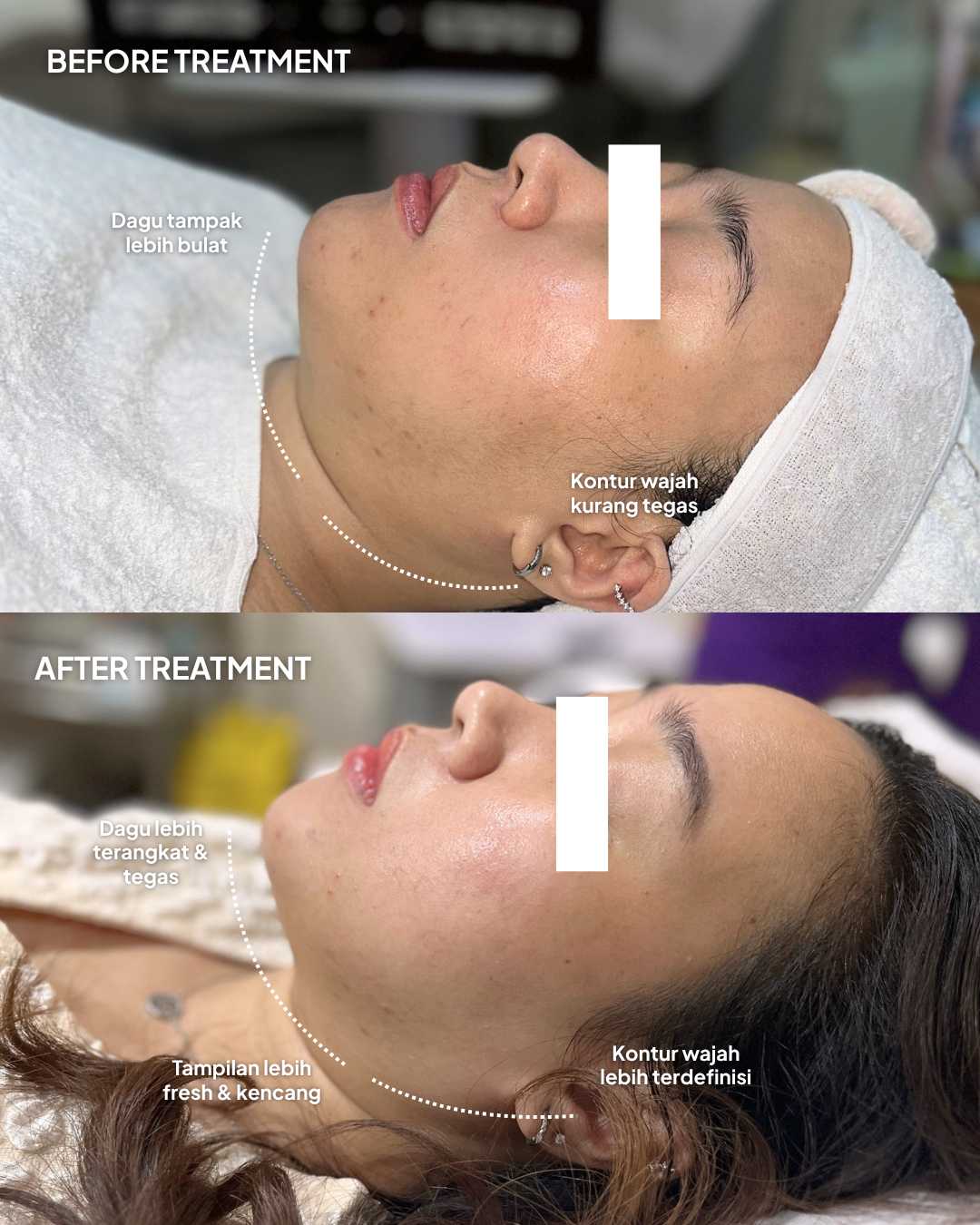 Before After Lifting Package - Garis Halus