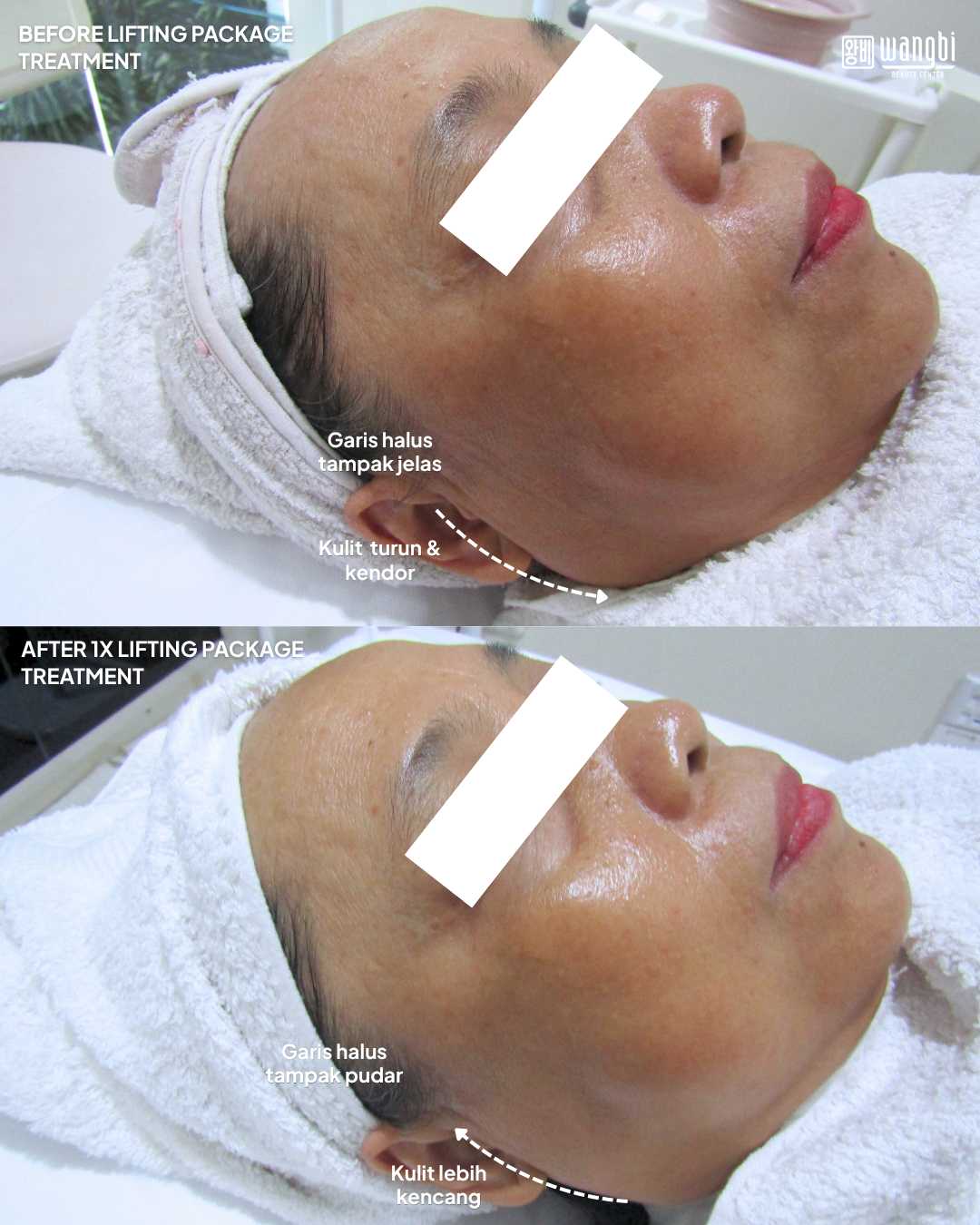 Before After Lifting Package - Double Chin