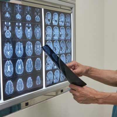 Akupunktur untuk rehabilitasi pasca stroke